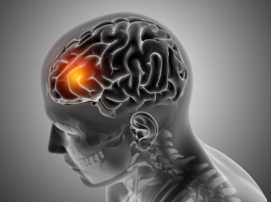 stroke1
